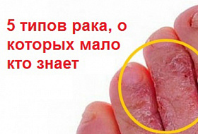 5 типов рака, о которых мало кто знает