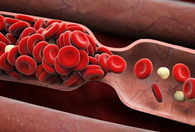 Признаки ТРОМБОВ в кровеносных сосудах