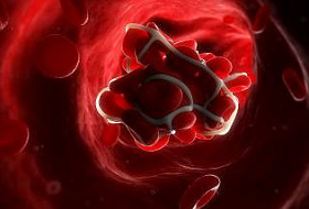 Это нужно знать! Профилактика образования тромбов