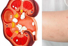 8 признаков того, что у вас проблемы с почками!