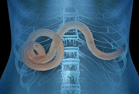 10 признаков, что у вас могут быть паразиты